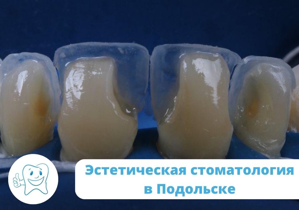Эстетическая стоматология в Подольске: возможности и тенденции |  Стоматология Улыбка